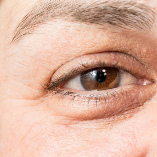 Causes, symptoms, and management of thyroid eye disease